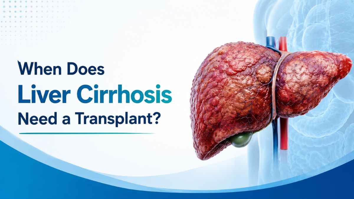 when does cirrhosis need a transplant